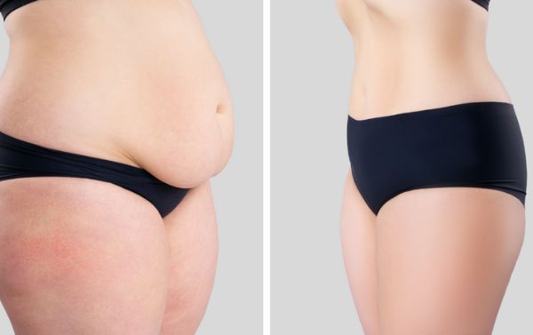 Abdominoplasty